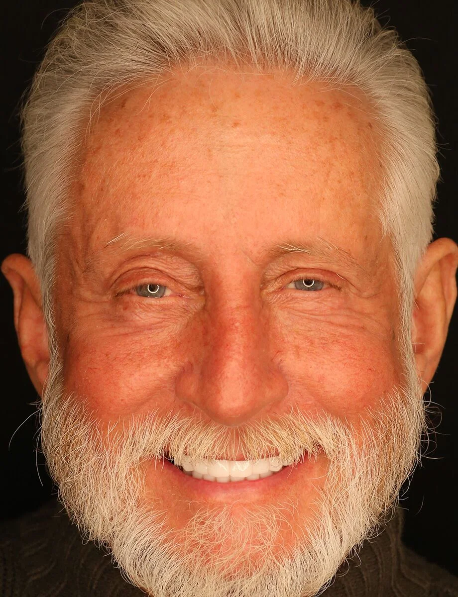 Full-arch transformation — after full-arch dental implants at Full Implant Choice