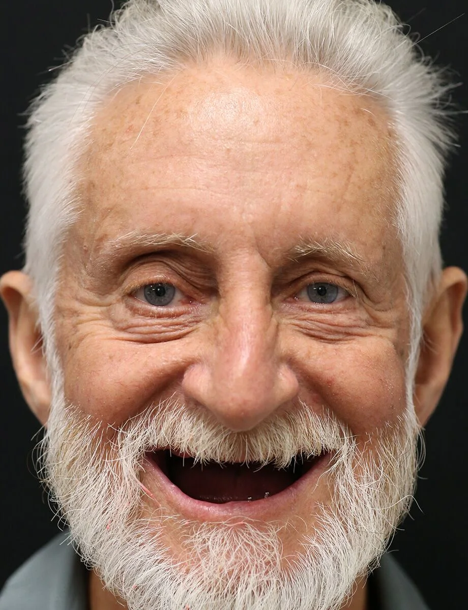Full-arch transformation — before treatment