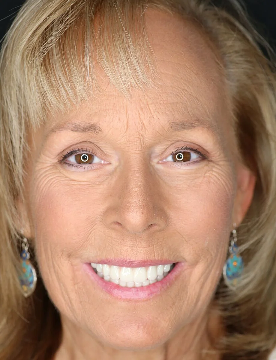 Full-arch transformation — after full-arch dental implants at Full Implant Choice
