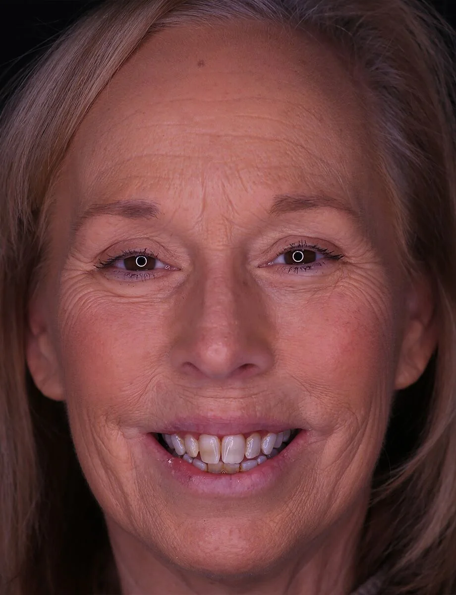 Full-arch transformation — before treatment