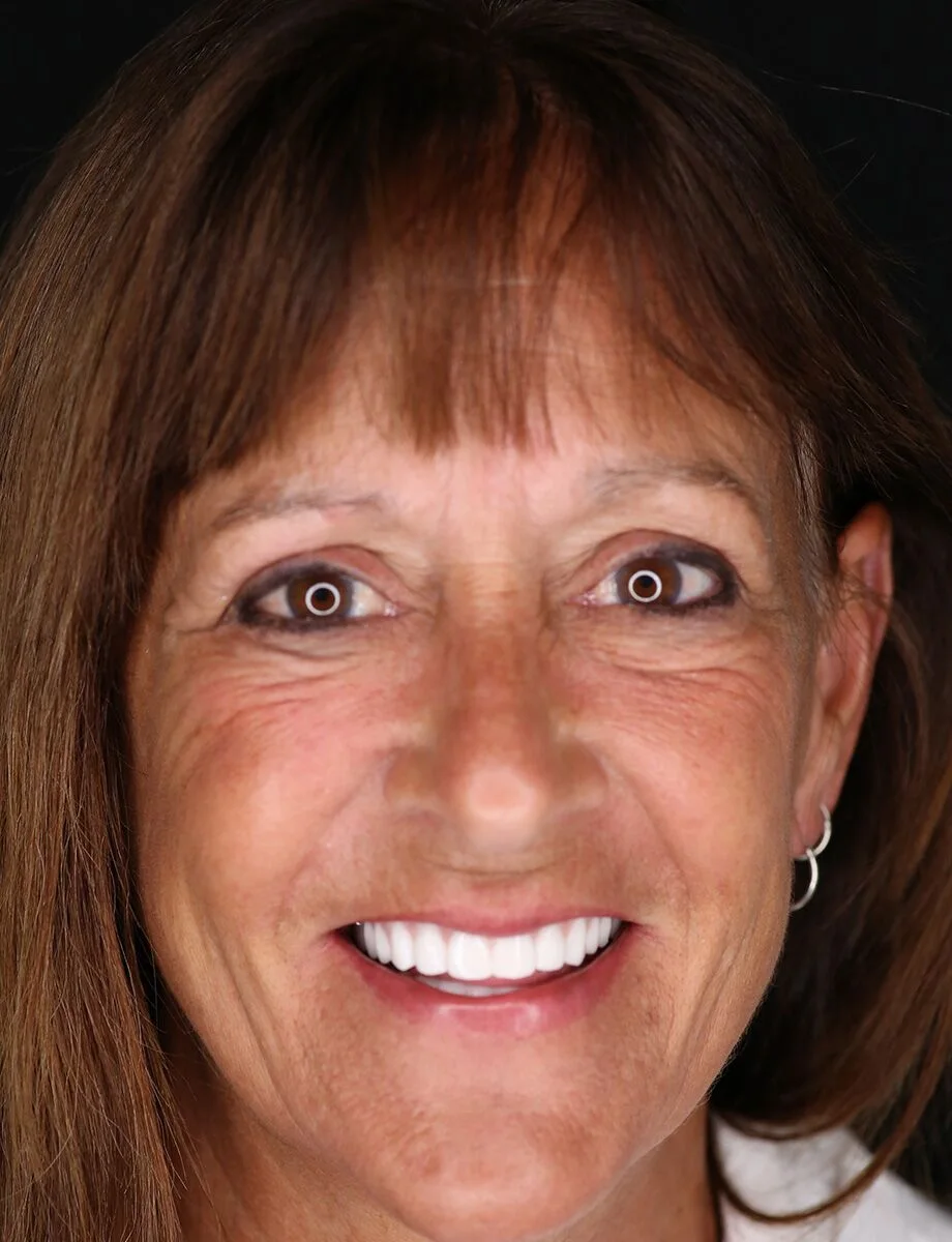 Full-arch transformation — Case 4 — after full-arch dental implants at Full Implant Choice