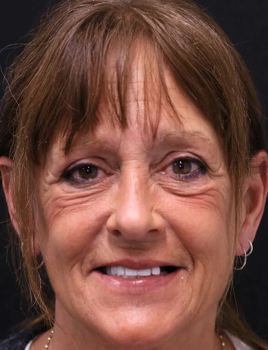 Full-arch transformation — Case 4 — before treatment