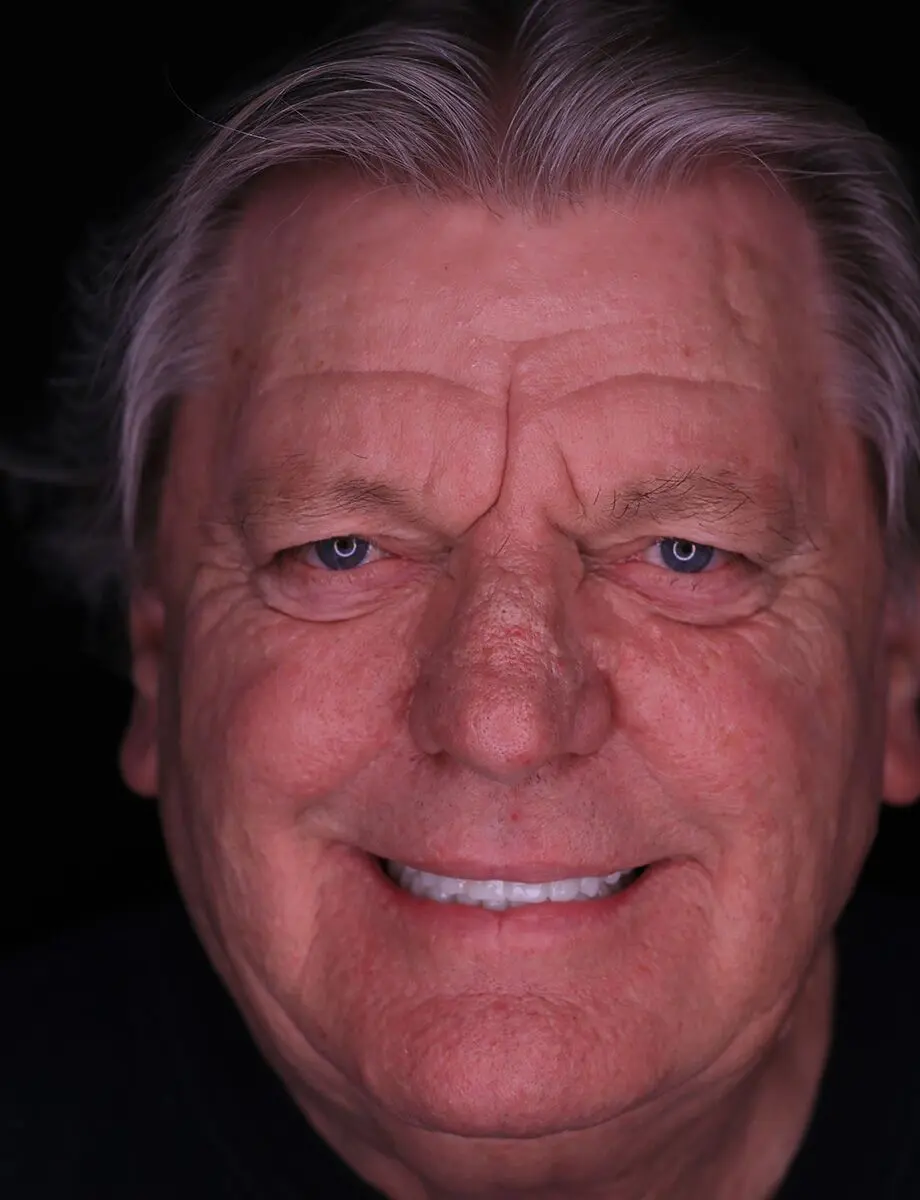 Full-arch transformation — Case 5 — after full-arch dental implants at Full Implant Choice