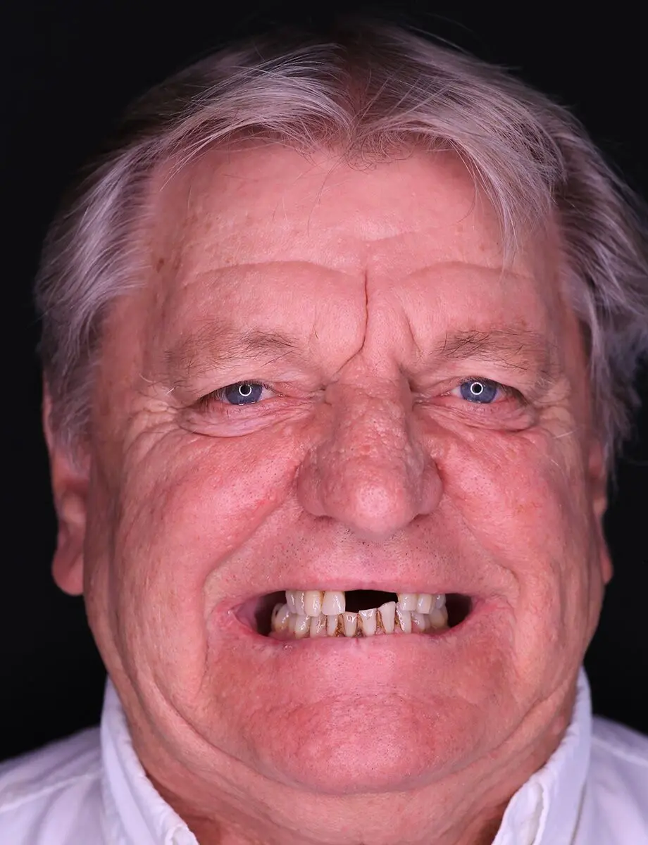 Full-arch transformation — Case 5 — before treatment