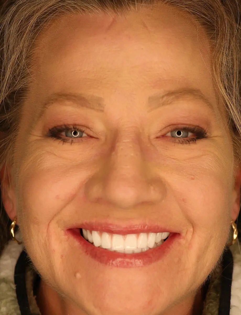 Full-arch transformation — Case 7 — after full-arch dental implants at Full Implant Choice