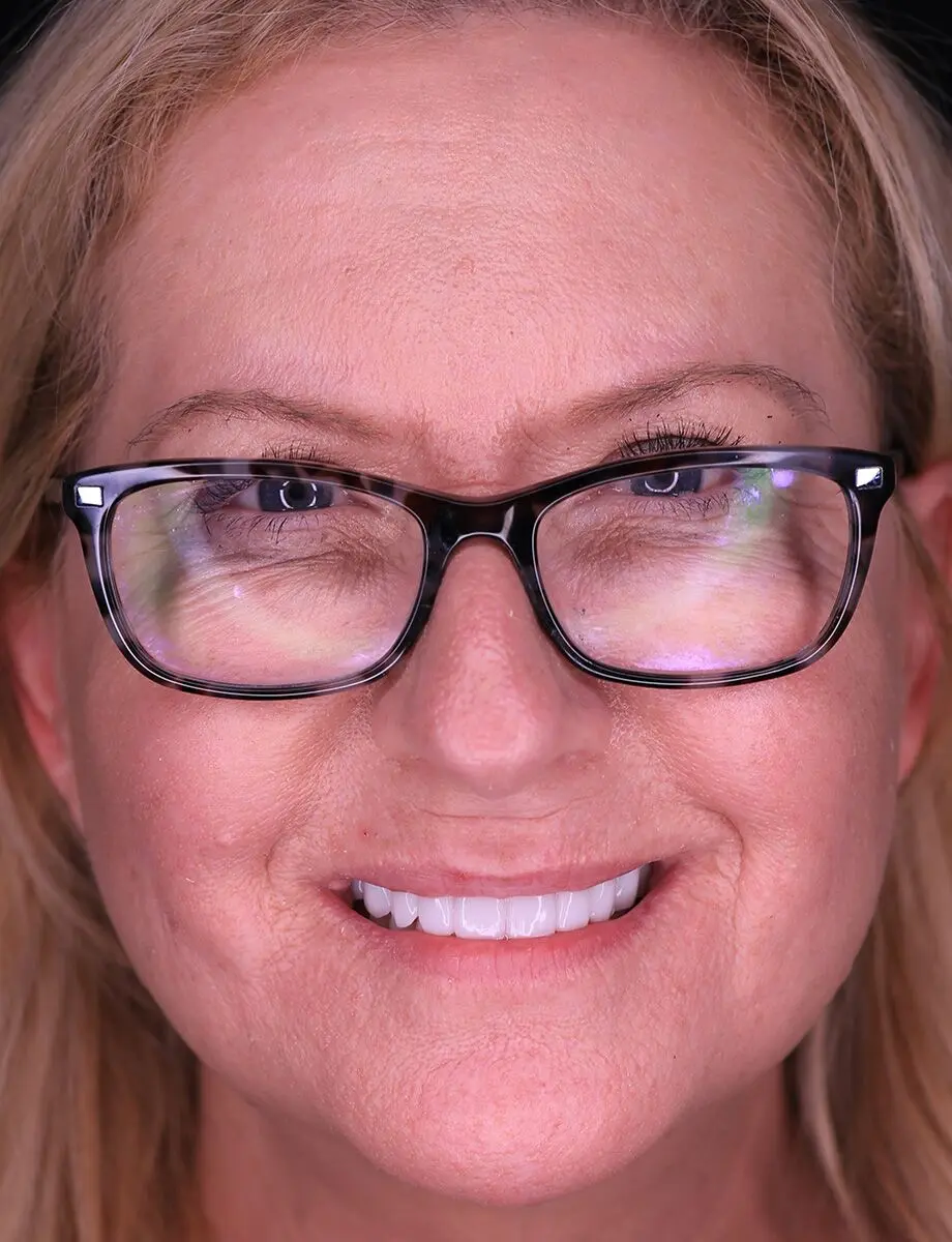 Full-arch transformation — Case 8 — after full-arch dental implants at Full Implant Choice