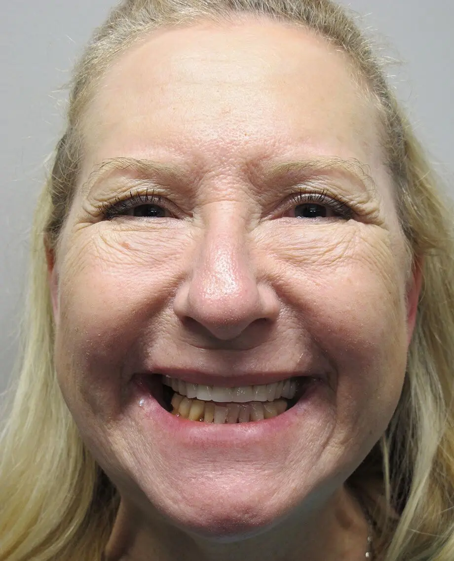 Full-arch transformation — Case 8 — before treatment