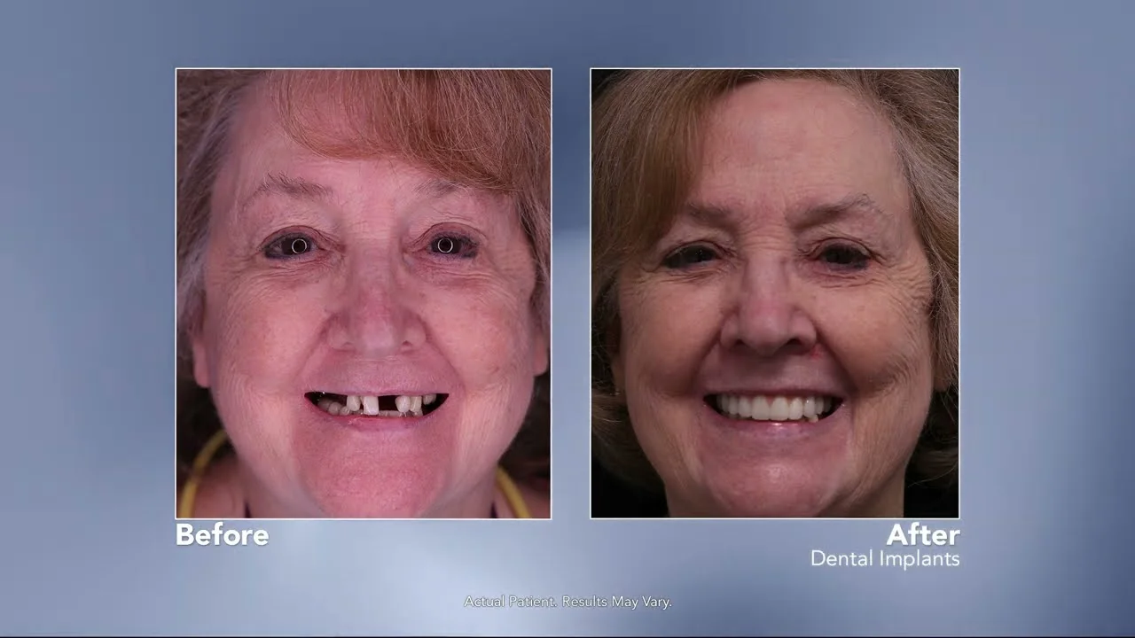 Replacing Missing Teeth with Dental Implants — Dr. Adam Hogan, DDS on The Wellness Hour